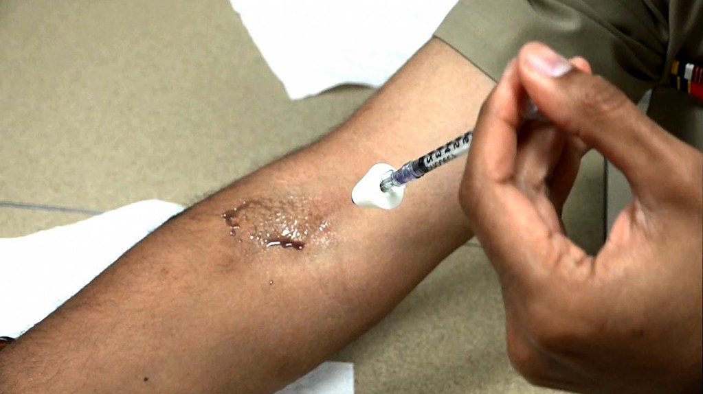 Experimental Eczema Therapy — related to eyecyte amniotic patches
